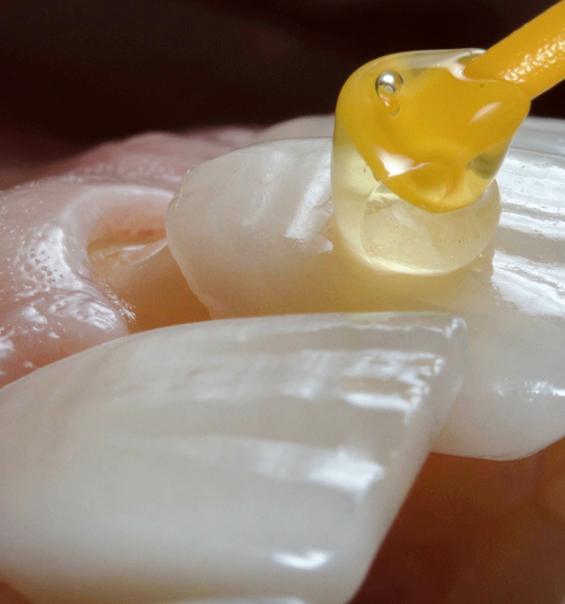 A closeup of veneers being placed on teeth