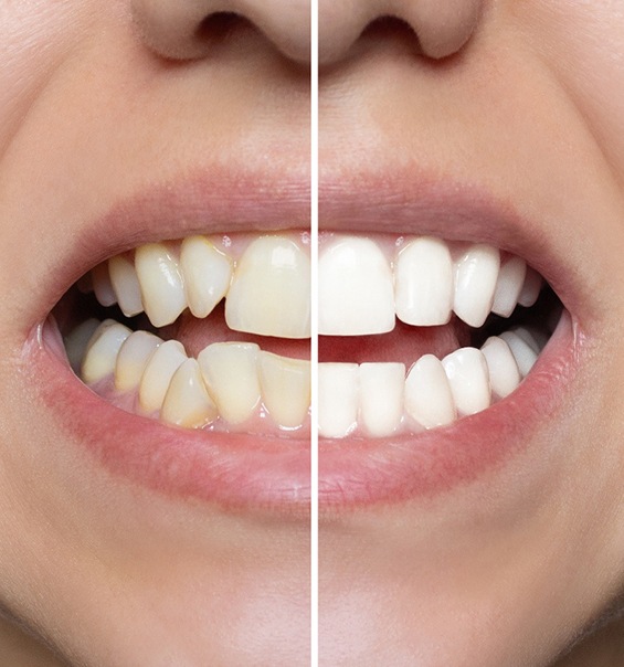 A before-and-after photo of a woman who got veneers