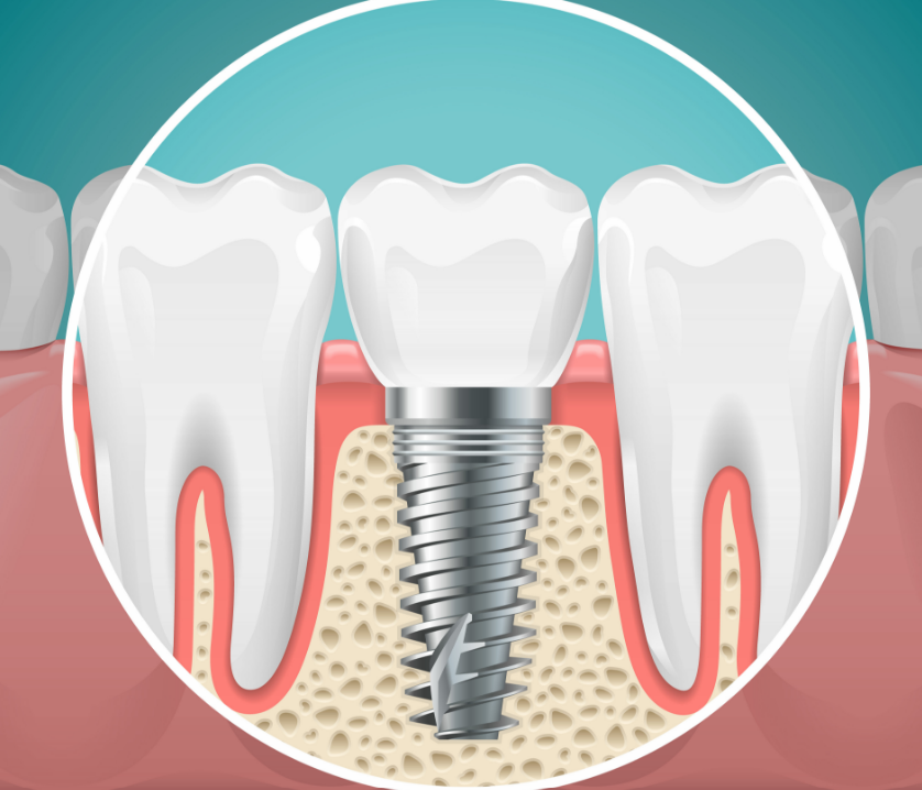 Illustrated cross section of a dental implant